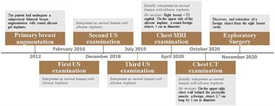 Long Term Rigid Retained Foreign Object After Breast Augmentation: A Case Report and Literature Review